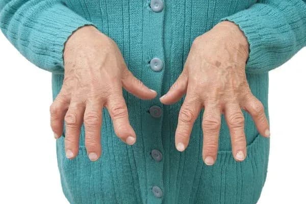 Rheumatoide Arthritis - Symptome und Behandlung