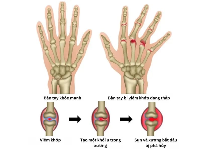 What foods should people with rheumatoid arthritis avoid?
